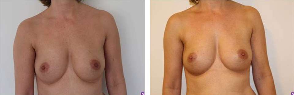 brystforstoer-eget-fedt-1